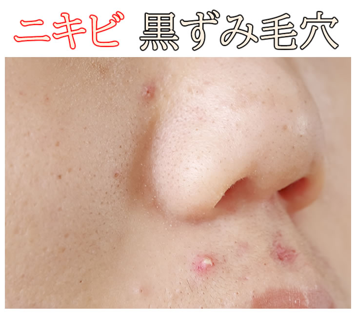 ニキビ 黒ずみ毛穴